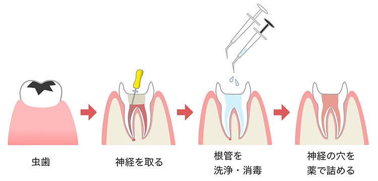 歯根治療について