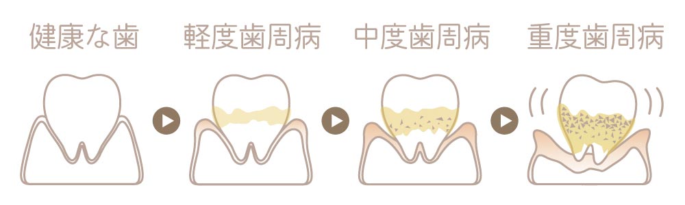 虫歯の進行と治療法