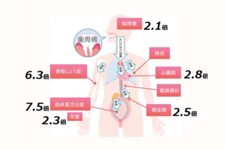 歯周病は全身疾患と関係している